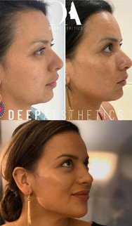 is jawline filler worth it