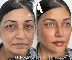 Is Tear Trough Filler Safe