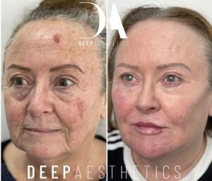 How Long Does Tear Trough Filler Last