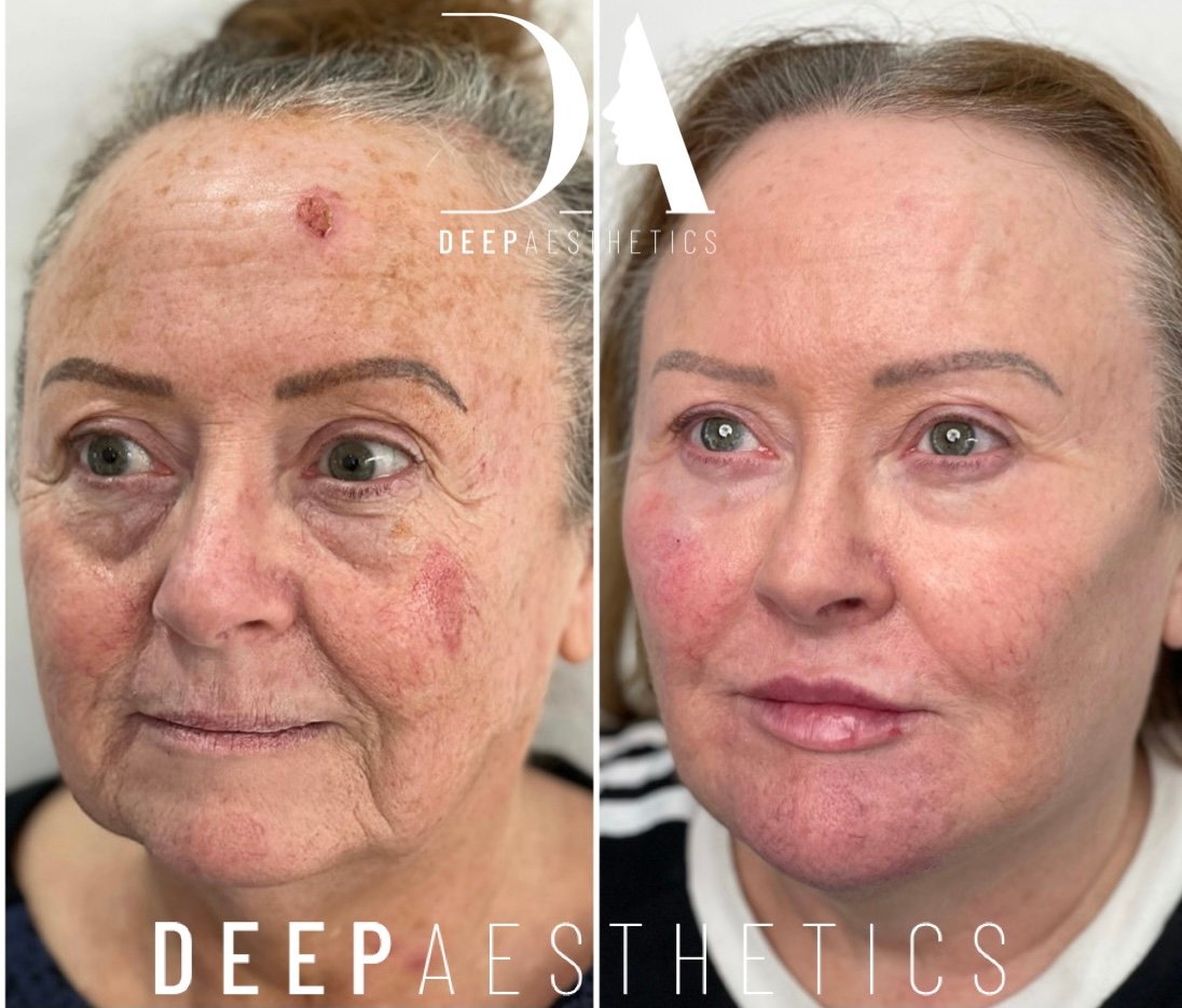 How Long Does Tear Trough Filler Last