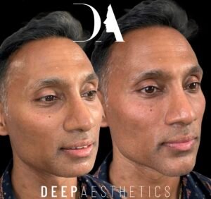 Endolift in Canary Wharf