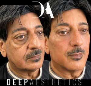 Endolift in Canary Wharf