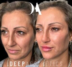 Endolift in Canary Wharf