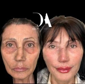 Endolift in Canary Wharf