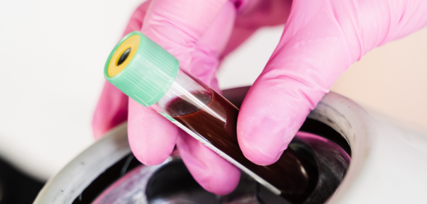 PRP Therapy in Canary Wharf