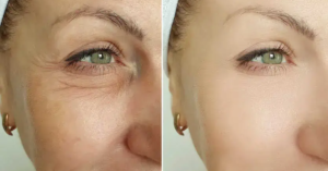 Endolaser for Non-Surgical Facelift