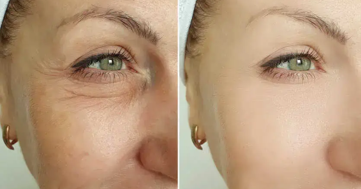 Endolaser for Non-Surgical Facelift