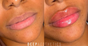 how much does lip enhancement cost uk