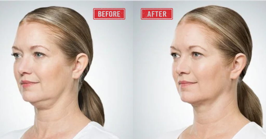 Do Fat Dissolving Injections Work