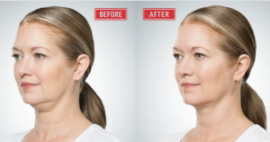 Do Fat Dissolving Injections Work
