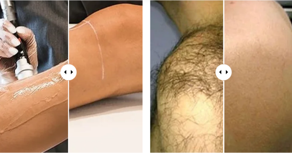 does laser hair removal hurt