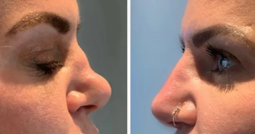 non-surgical rhinoplasty cost uk