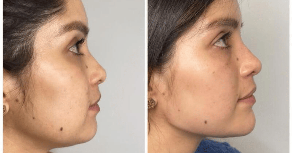 is jawline filler worth it