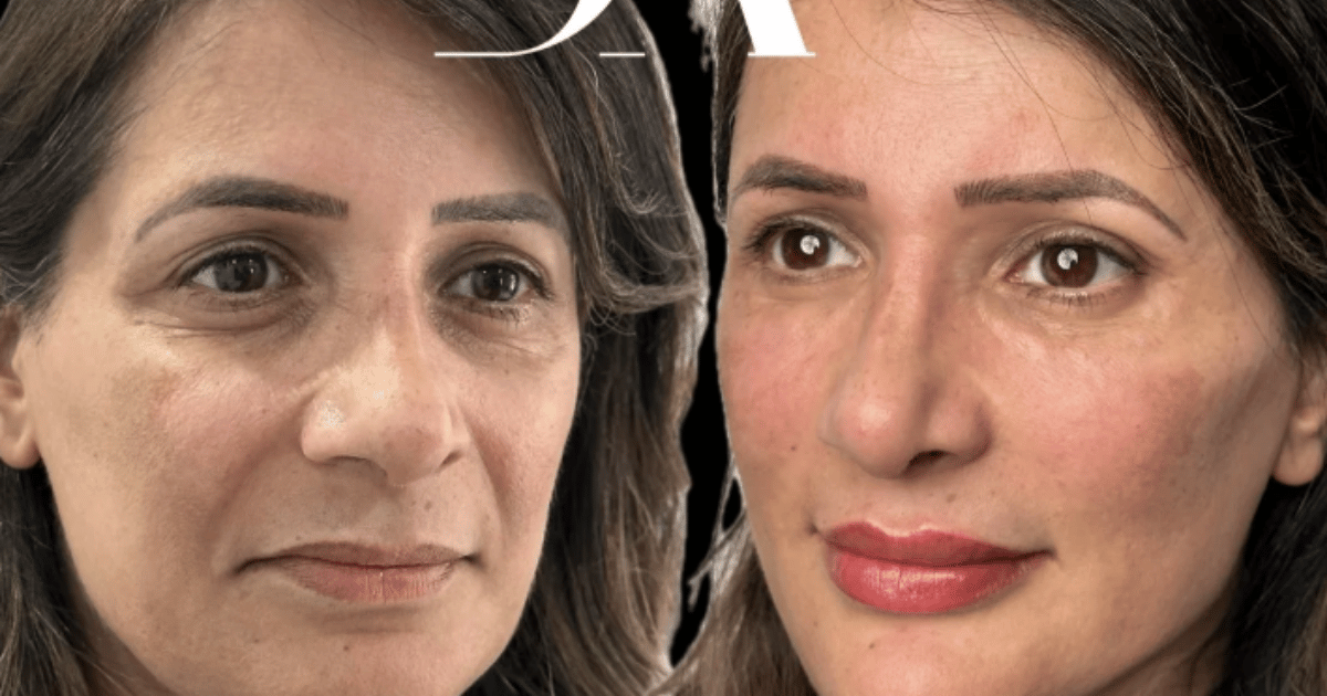 does tear trough filler hurt