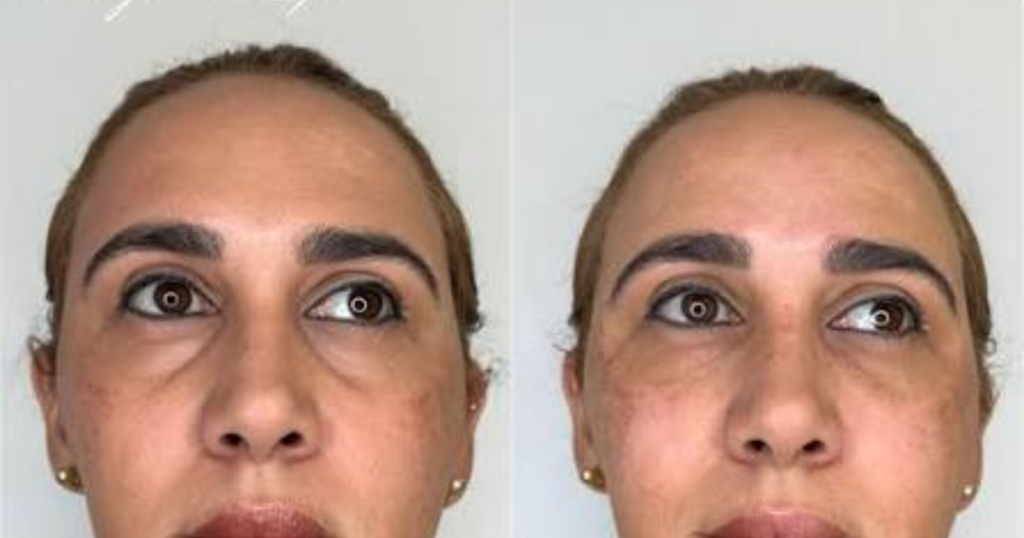 Does Tear Trough Filler Make Eyes Smaller