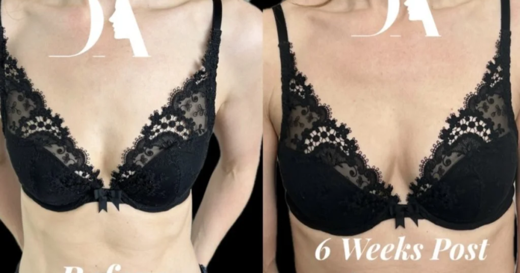 how much does breast enlargement cost