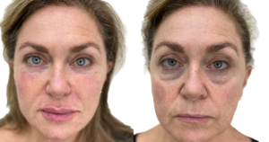 jawline filler vs chin filler
