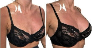 non-surgical breast enlargement