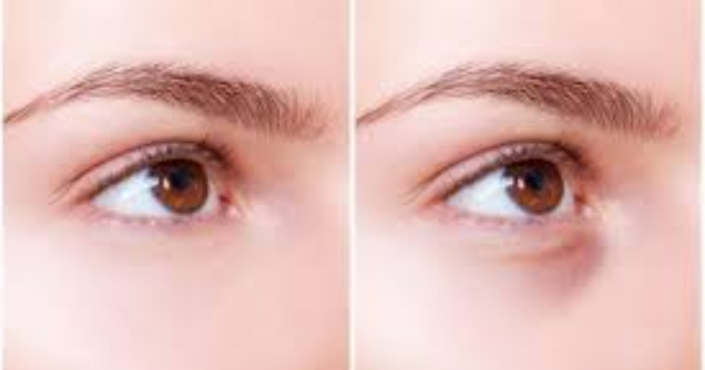 Which Filler Is Best for Tear Troughs