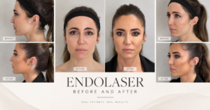 Endolaser before and after results for skin tightening in London