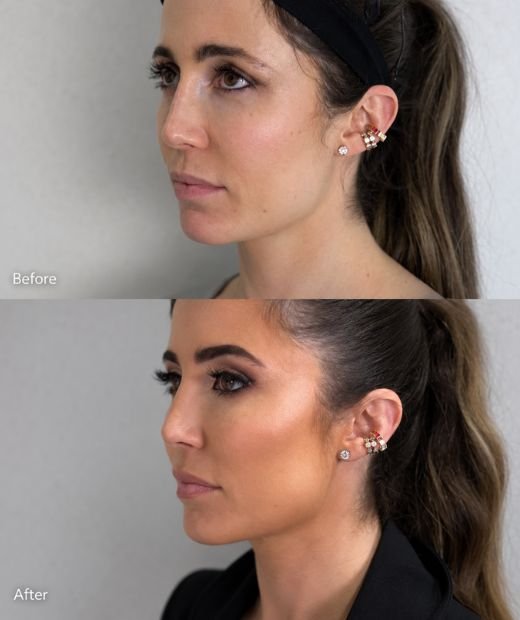 How Does Endolaser Jawline and Double Chin Work