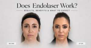 Does Endolaser Work? Results, Benefits & What to Expect