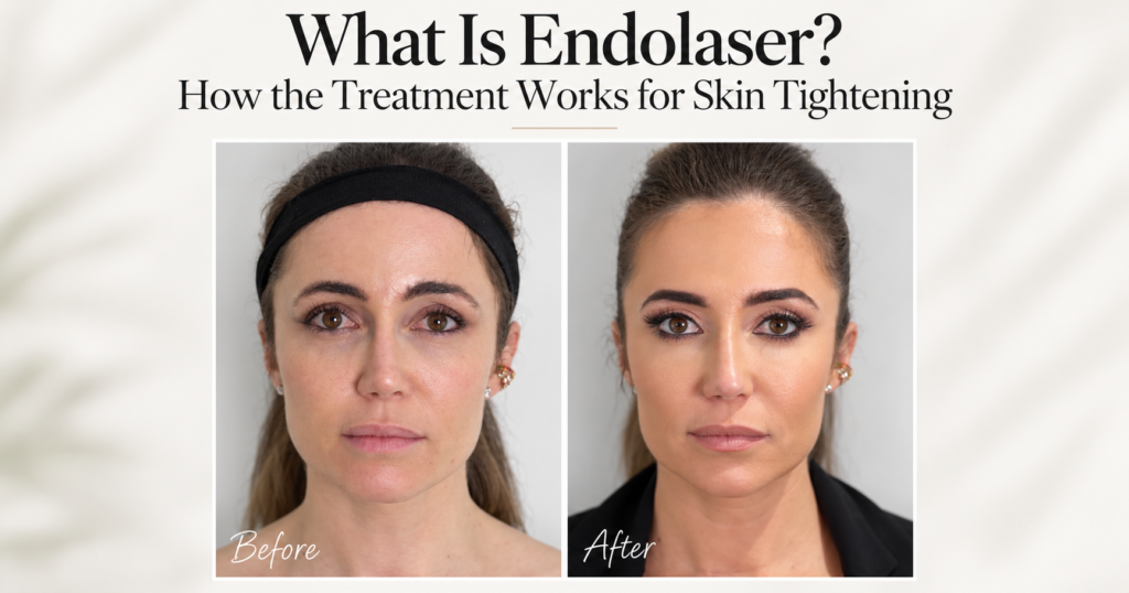 What Is Endolaser? How the Treatment Works for Skin Tightening