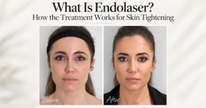 What Is Endolaser? How the Treatment Works for Skin Tightening