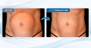 how many Emsculpt Neo sessions do you need
